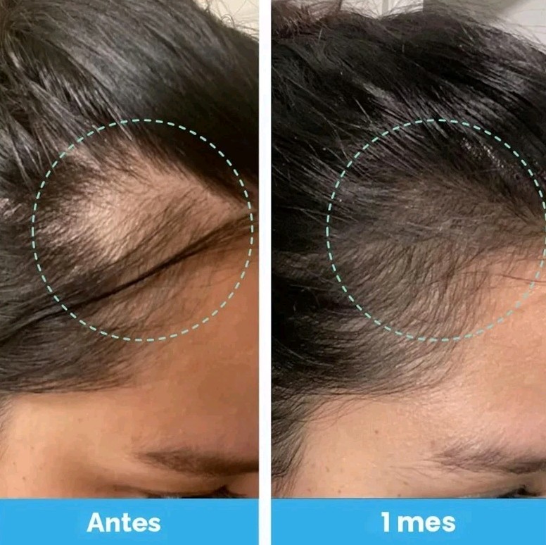 Baby Blues Postpartum Hair Loss Vitamins Passion Fruit Gummies Biotin Collagen