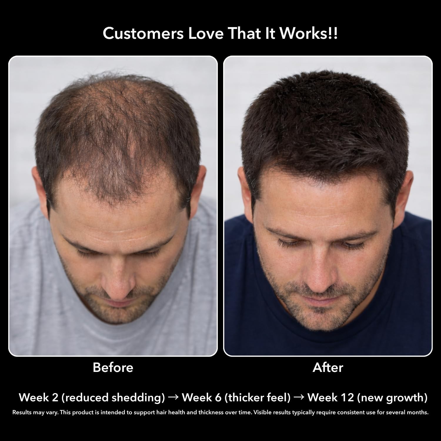 DHT Blocker for Men – Biotin 10000mcg, Saw Palmetto, MSM – Supports Hair Growth,