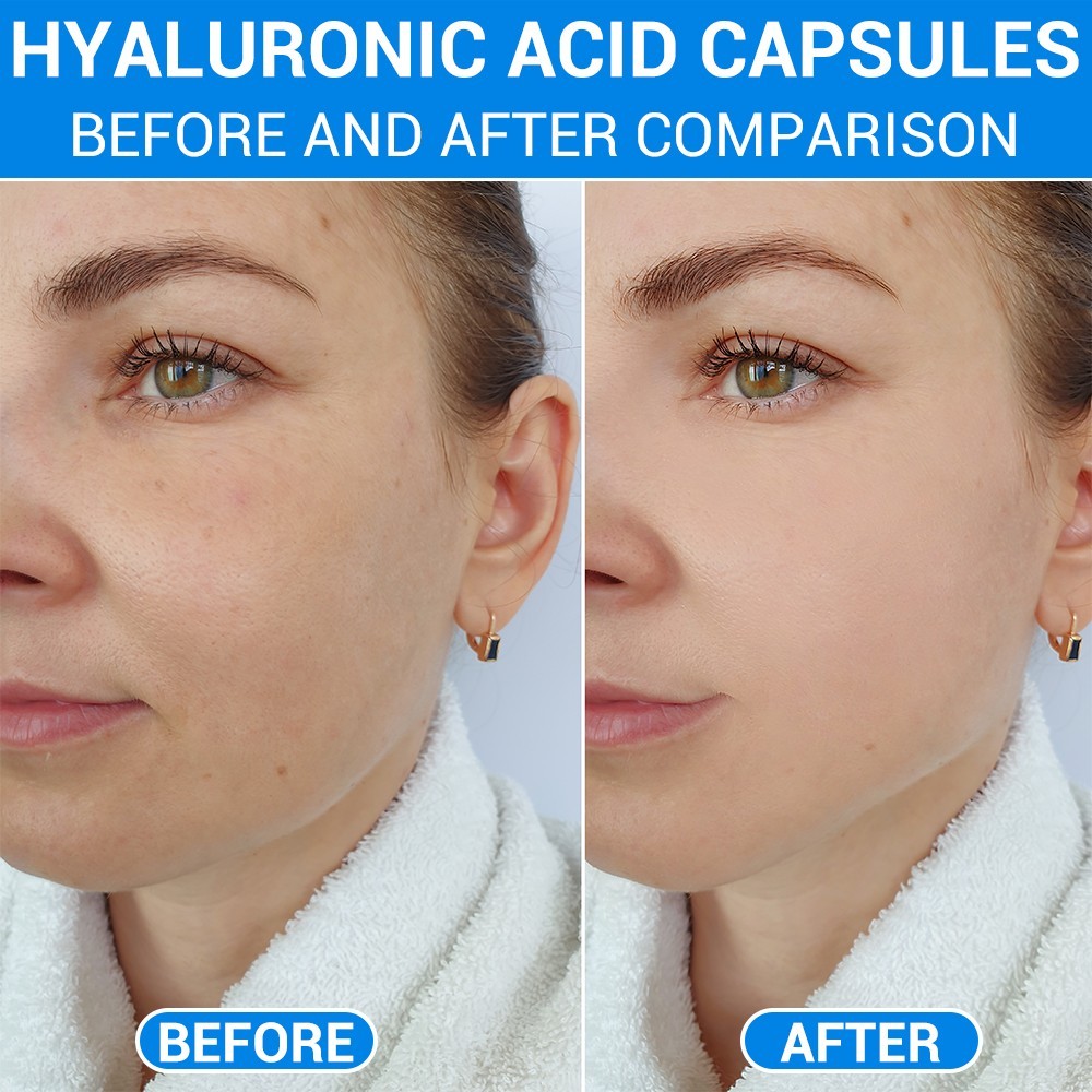 Hydrating Hyaluronic Acid Capsules Supports Anti-Aging Wrinkles & Joint Wellness