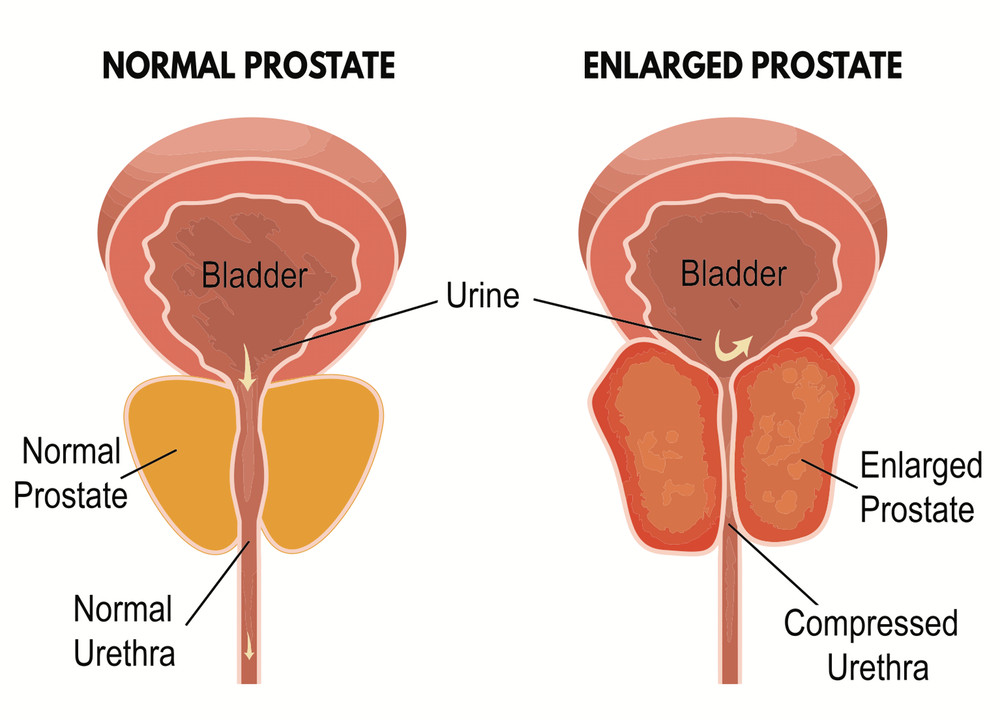 Ultimate Superfood Detox – PROSTATE HEALTH – Natural Energy and Immunity 3Bot